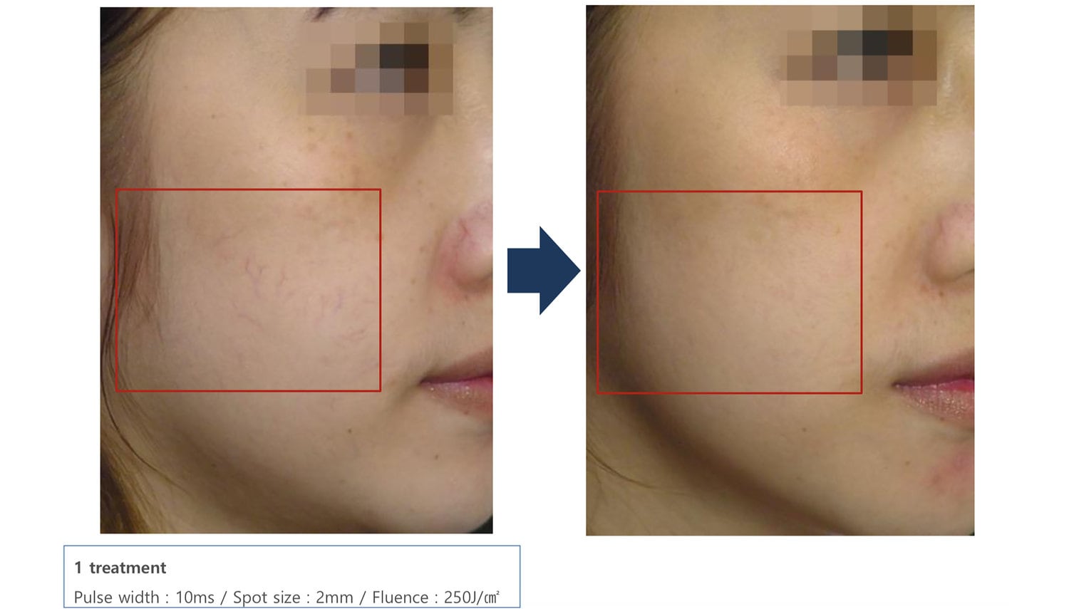 laser skin treatments before and after
